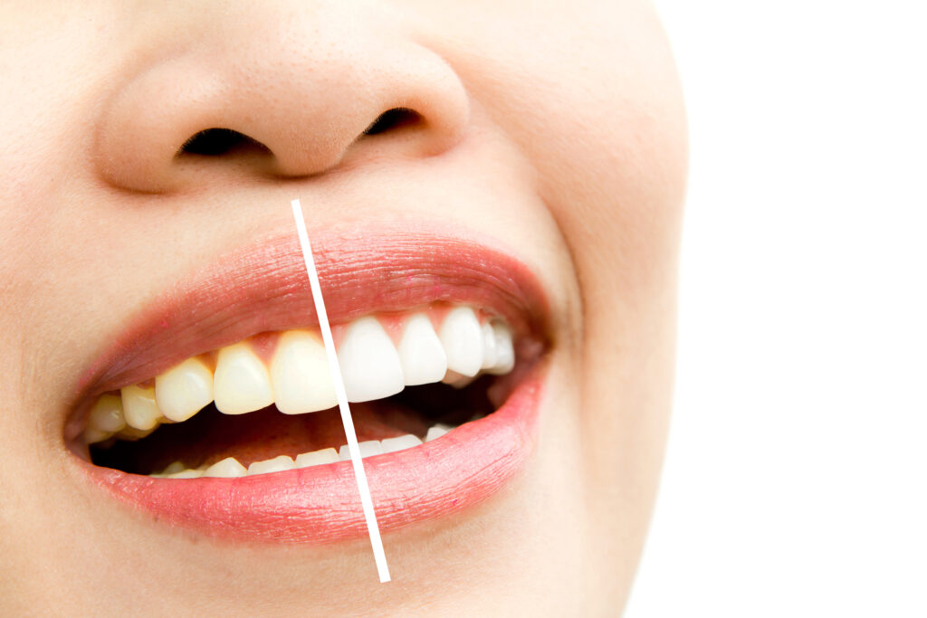 Before and after teeth whitening treatment
